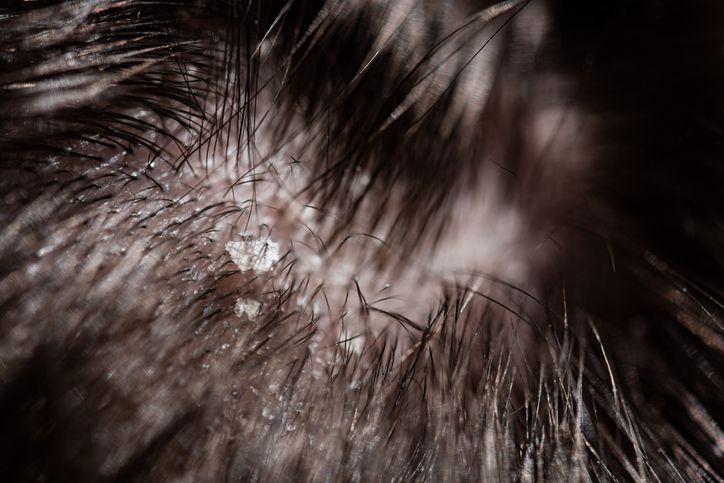 頭皮屑脫髮點算好？髮理專家分享6招頭皮護理方法+4款醫學級治療 從根源徹底解決頭皮屑與稀疏髮量！