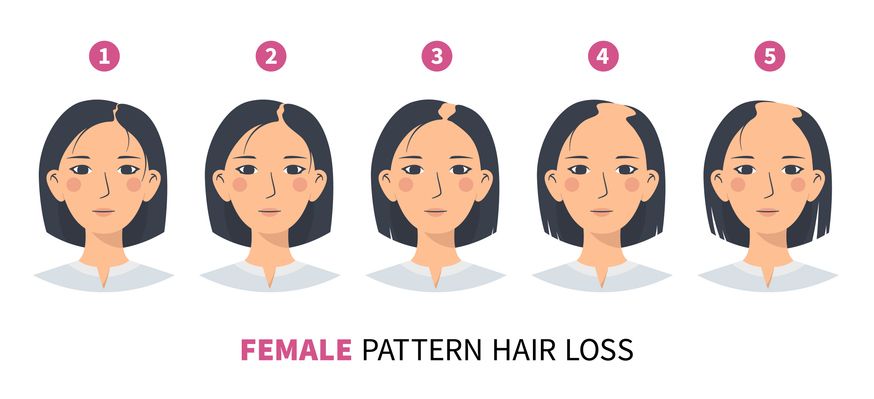 女性脫髮：女生禿頭的3大關鍵指標！破解6大脫髮成因與6大救髮對策！